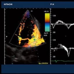 Hitachi Ultrasound Machine